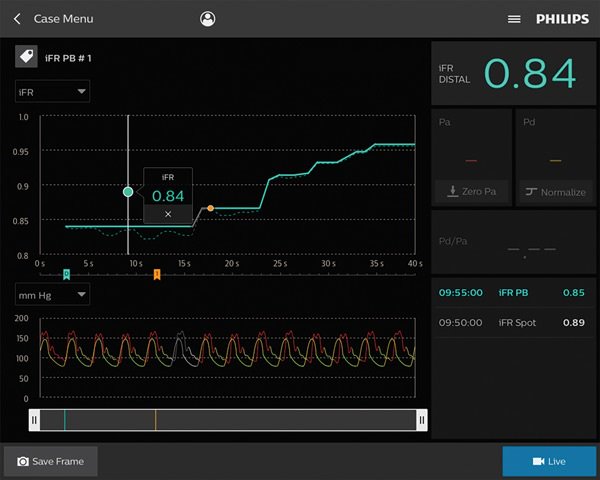 Coronary pressure and flow wires
