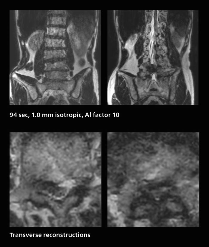 Fast lumbar spine MRI with SmartSpeed of a patient in pain produced a successful isotropic diagnostic scan in only 94 minutes, mobile one