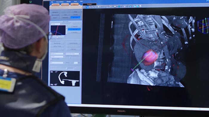 Tumor biopsy and ablation