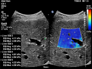 EPIQ_Normal Liver with multiple measurements_ElastQ