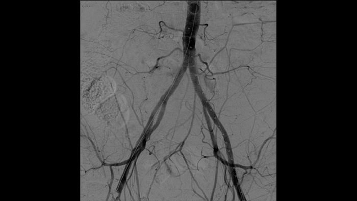 Vascular processing